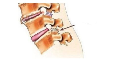 spondyloarthrosis کمر میں درد کا سبب بنتا ہے