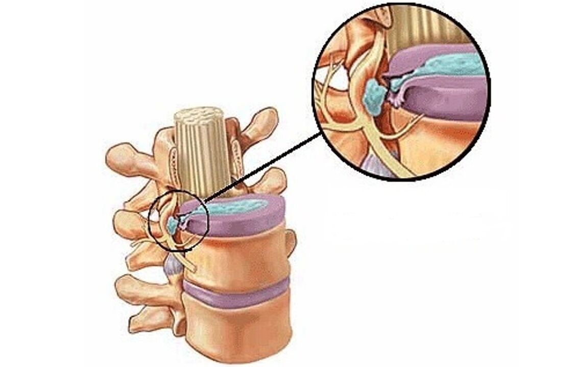 چھاتی کے osteochondrosis کے ساتھ انٹرورٹیبرل ہرنیا