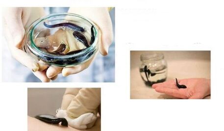 arthrosis کے لئے hirudotherapy